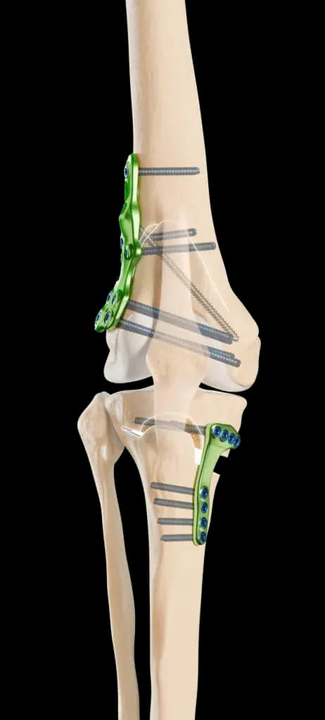 Cirujanos Ortopédicos trabajando en rodilla